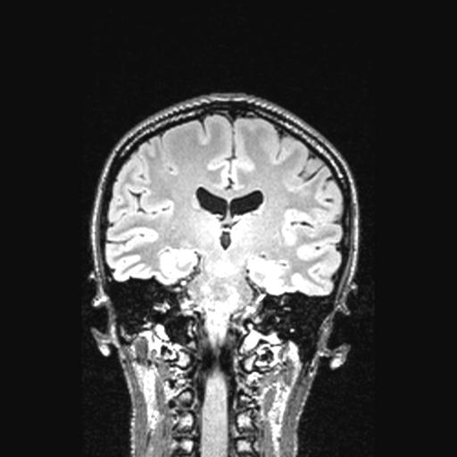 Atretic encephalocoele with inferior vermis hypoplasia (Radiopaedia 30443-31108 Coronal FLAIR 84).jpg