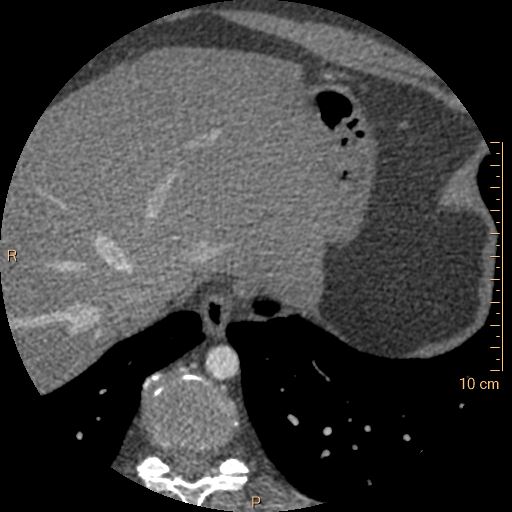 Atrial septal defect (upper sinus venosus type) with partial anomalous pulmonary venous return into superior vena cava (Radiopaedia 73228-83961 A 271).jpg