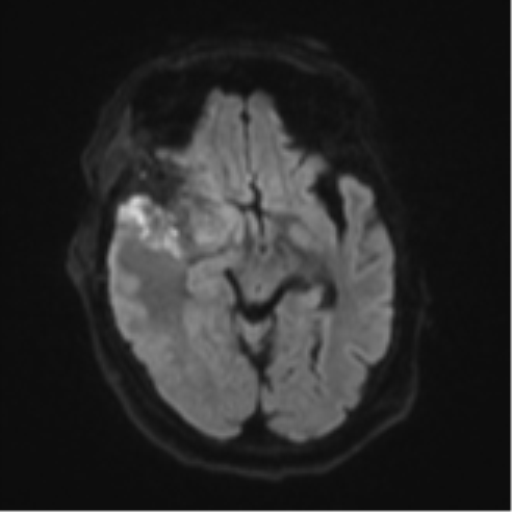 Atypical meningioma (WHO Grade II) (Radiopaedia 54742-60981 Axial DWI 40).png