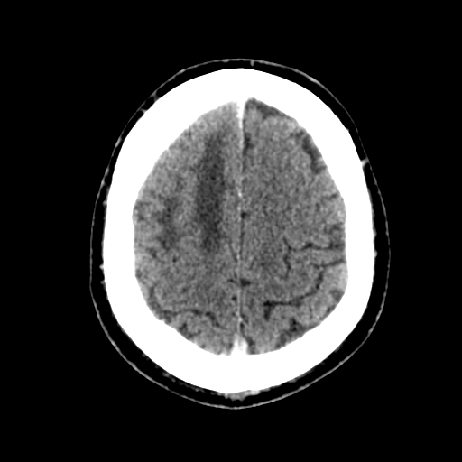 File:Atypical meningioma (WHO grade II) with brain invasion (Radiopaedia 57767-64728 Axial C+ 12).png