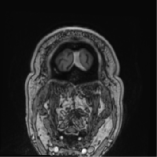 File:Atypical meningioma (WHO grade II) with brain invasion (Radiopaedia 57767-64729 Coronal T1 C+ 82).png
