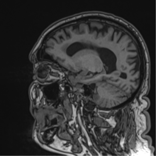 Atypical meningioma (WHO grade II) with brain invasion (Radiopaedia 57767-64729 Sagittal T1 28).png
