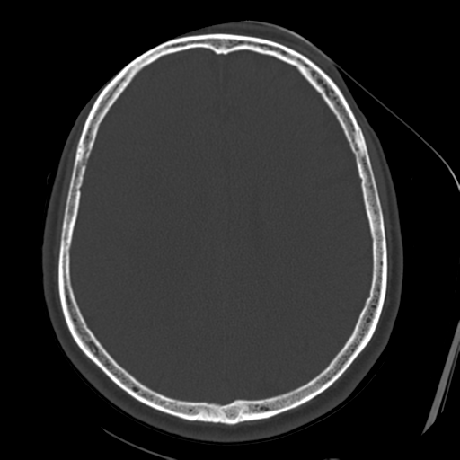 Atypical meningioma with skull invasion (Radiopaedia 34357-35649 Axial bone window 53).png