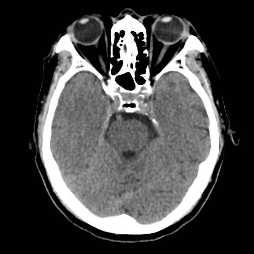 Atypical meningioma with skull invasion (Radiopaedia 34357-35649 Axial non-contrast 19).png