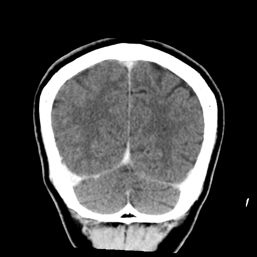 Atypical meningioma with skull invasion (Radiopaedia 34357-35649 Coronal C+ delayed 48).png