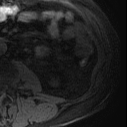 File:Atypical renal cyst on MRI (Radiopaedia 17349-17046 Axial T1 fat sat 31).jpg