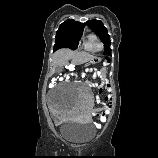 File:Atypical retroperitoneal lymphocoeles with large leiomyoma of uterus (Radiopaedia 32084-33024 B 5).jpg