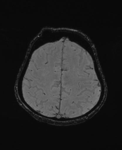 Autoimmune limbic encephalitis (Radiopaedia 30363-31005 SWI - magnitude 62).jpg
