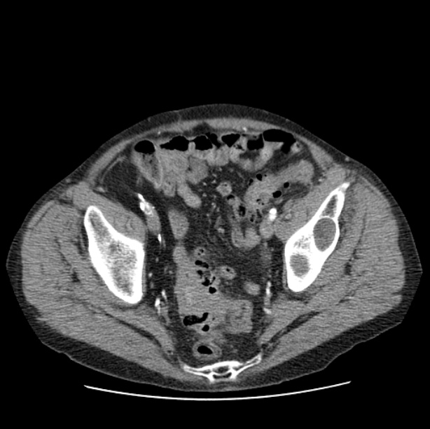 Autosomal dominant polycystic kidney disease (Radiopaedia 27851-28094 B 107).jpg