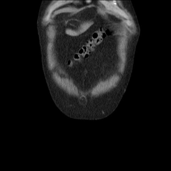 Autosomal dominant polycystic kidney disease (Radiopaedia 36539-38101 C 8).jpg
