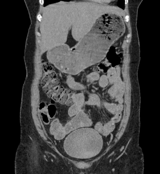 Autosomal dominant polycystic kidney disease (Radiopaedia 38189-40194 Coronal C+ delayed 14).jpg
