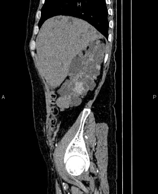 Autosomal dominant polycystic kidney disease (Radiopaedia 87830-104287 C 16).jpg