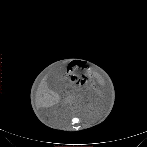 Autosomal recessive polycystic kidney disease associated with Caroli disease (Radiopaedia 61932-69984 Axial non-contrast 200).jpg