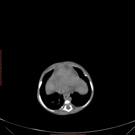 Autosomal recessive polycystic kidney disease associated with Caroli disease (Radiopaedia 61932-69984 Axial non-contrast 96).jpg