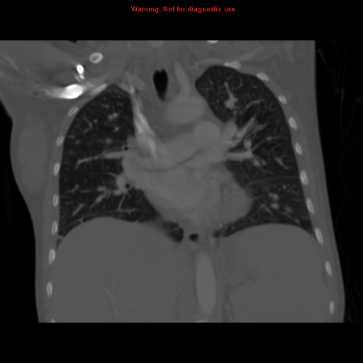 File:Avascular necrosis in sickle cell disease (Radiopaedia 17448-17152 Coronal bone window 65).jpg