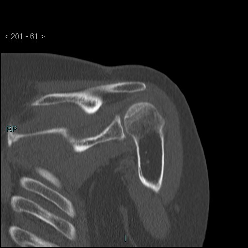 Avascular necrosis of the shoulder - Cruess stage I (Radiopaedia 77674-89887 Coronal bone window 60).jpg
