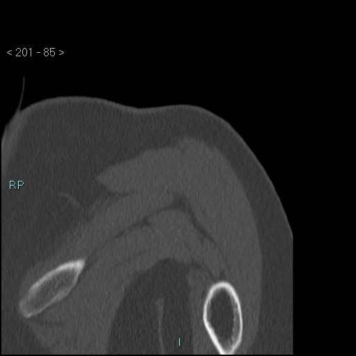 Avascular necrosis of the shoulder - Cruess stage I (Radiopaedia 77674-89887 Coronal bone window 84).jpg