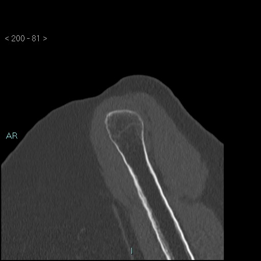 Avascular necrosis of the shoulder - Cruess stage I (Radiopaedia 77674-89887 Sagittal bone window 80).jpg
