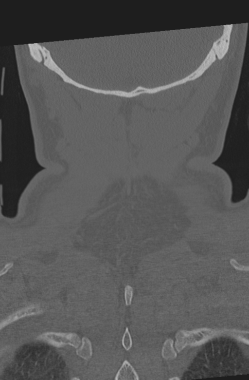 Axis peg fracture (type 3) and atlas lateral mass (type 4) fracture (Radiopaedia 37474-39324 Coronal bone window 59).png