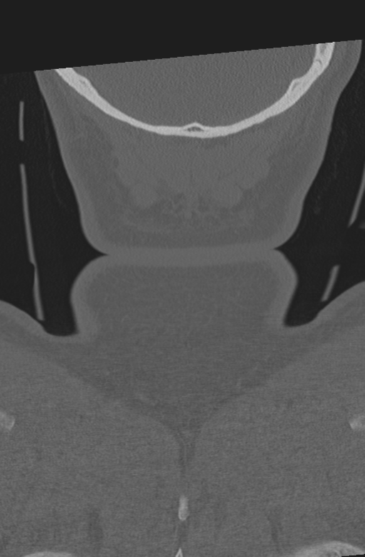 Axis peg fracture (type 3) and atlas lateral mass (type 4) fracture (Radiopaedia 37474-39324 Coronal bone window 69).png