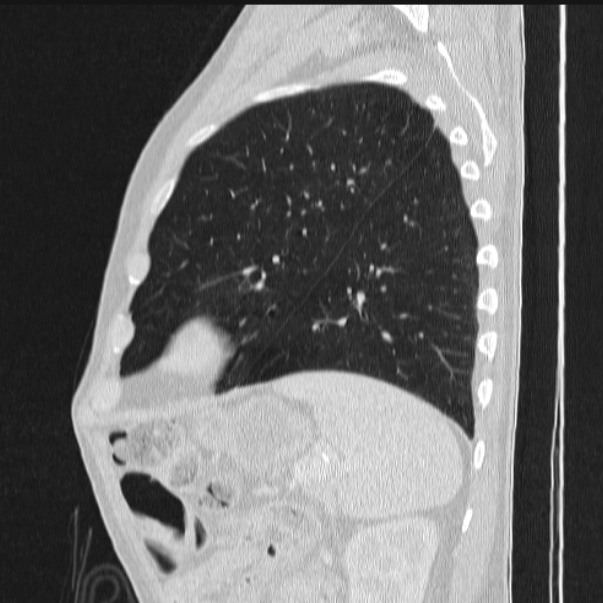 Azygos lobe (Radiopaedia 38259-40275 lung window 78).jpg