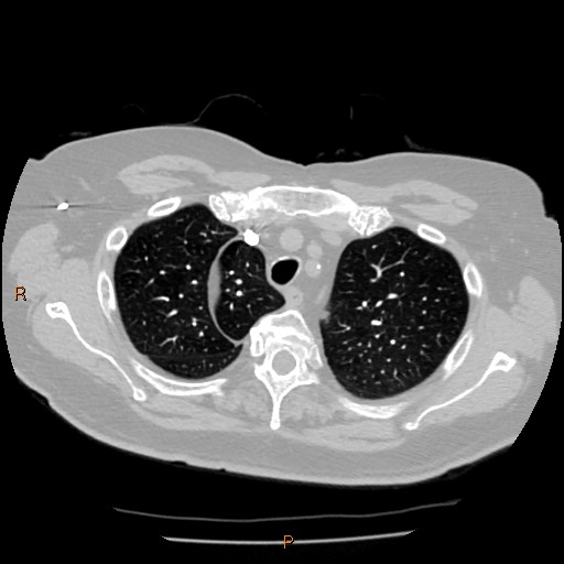 Azygos lobe (Radiopaedia 40161-42821 Axial lung window 10).jpg