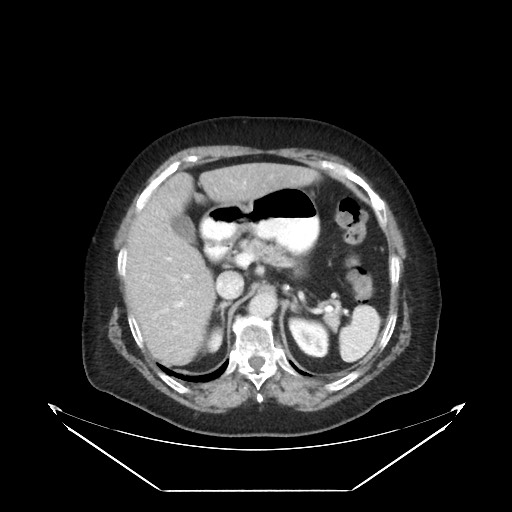 B-cell lymphoma of the mesentery (Radiopaedia 65711-74827 A 34).jpg