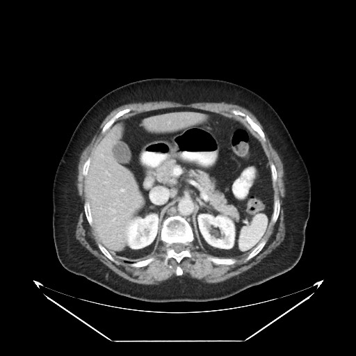 B-cell lymphoma of the mesentery (Radiopaedia 65711-74827 A 39).jpg