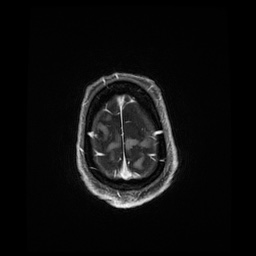Balo concentric sclerosis (Radiopaedia 53875-59982 Axial LAVA C+ 240).jpg