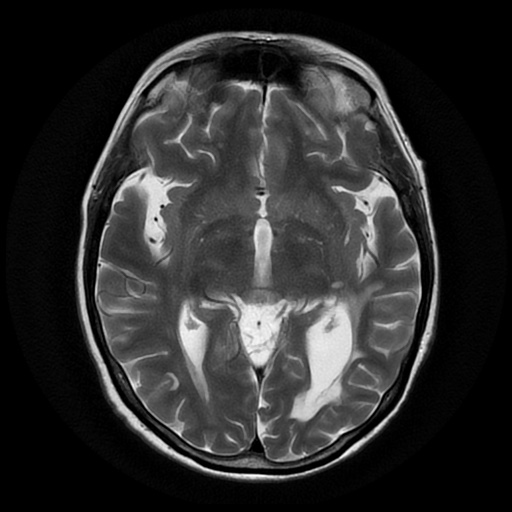 File:Balo concentric sclerosis (Radiopaedia 53875-59982 Axial T2 12).jpg