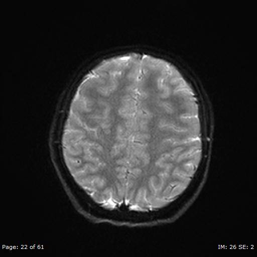 File:Balo concentric sclerosis (Radiopaedia 61637-69636 Axial DWI 22).jpg