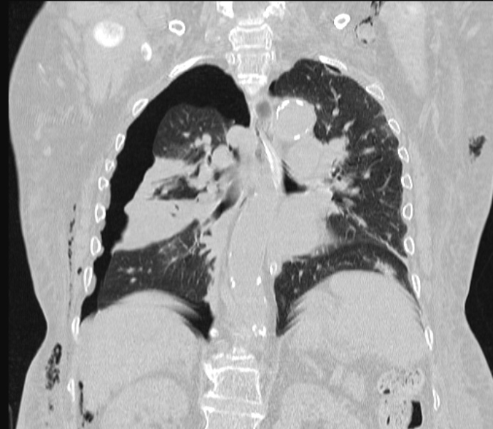 Barotrauma due to mechanical ventilation (Radiopaedia 28079-28336 Coronal lung window 59).jpg