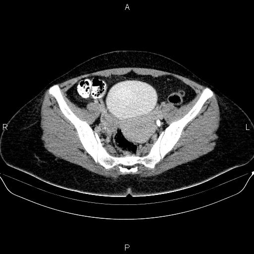 Bartholin gland cyst (Radiopaedia 62635-70930 C 36).jpg