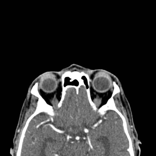 File:Basal cell carcinoma (periocular with orbital invasion) (Radiopaedia 30974-31672 Axial Postcontrast 23).jpg