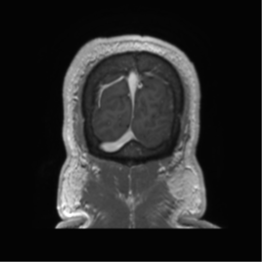 Basal ganglia hemorrhage - hypertensive (Radiopaedia 42227-45303 Coronal T1 C+ 19).png
