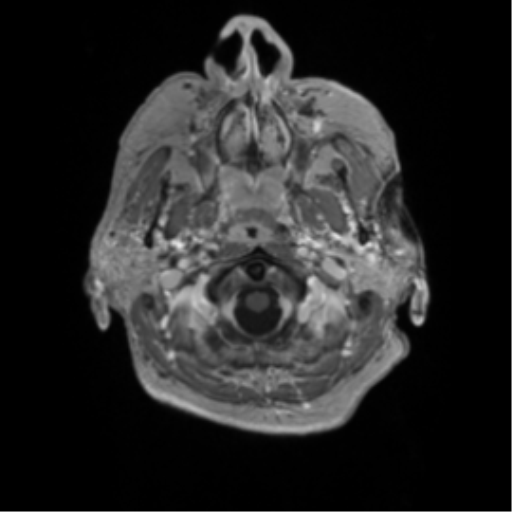 Basal ganglia metastasis (Radiopaedia 78928-91828 Axial T1 C+ 2).png