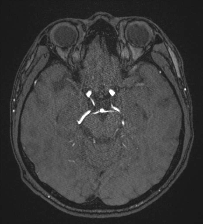 Basal ganglia subacute infarct (Radiopaedia 80201-93521 Axial MRA 50).png