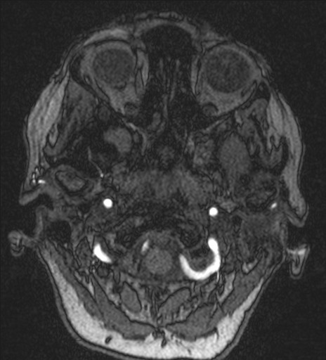 Basilar tip aneurysm (Radiopaedia 26504-26632 MRA 16).jpg