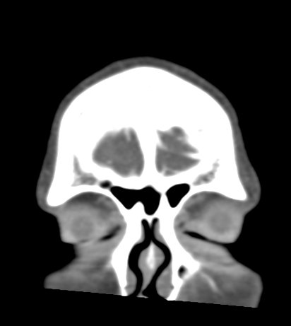 File:Basilar tip aneurysm with coiling (Radiopaedia 53912-60086 B 4).jpg