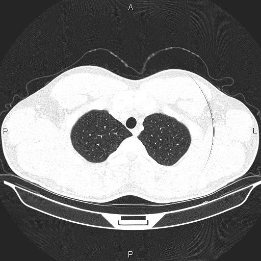 File:Beam hardening and ring artifacts (Radiopaedia 85323-100915 Axial lung window 15).jpg