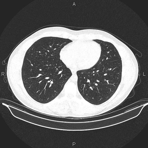Beam hardening and ring artifacts (Radiopaedia 85323-100915 Axial lung window 52).jpg