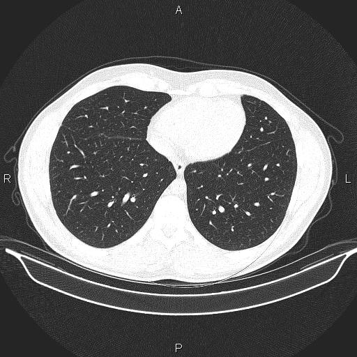 Beam hardening and ring artifacts (Radiopaedia 85323-100915 Axial lung window 56).jpg