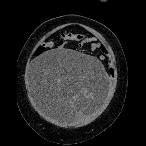 File:Benign leiomyoma with hydropic features (Radiopaedia 89250-106130 B 29).jpg