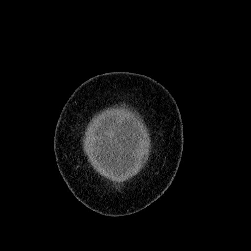 File:Benign leiomyoma with hydropic features (Radiopaedia 89250-106130 B 6).jpg