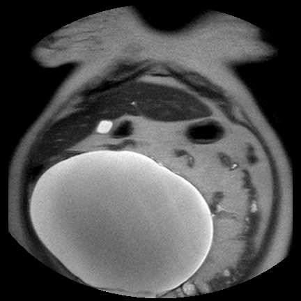File:Benign seromucinous cystadenoma of the ovary (Radiopaedia 71065-81300 Coronal T2 11).jpg