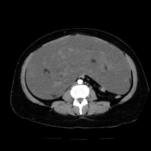 Benign spindle cell tumor - abdominopelvic (Radiopaedia 61300-69212 A 35).jpg