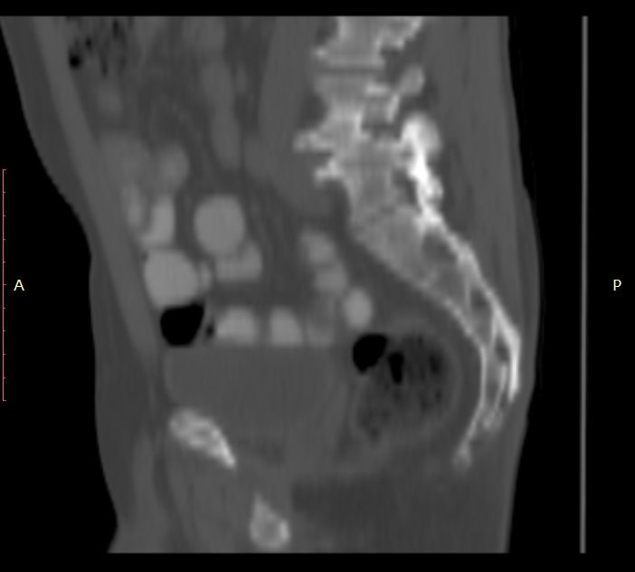 Bertolotti syndrome (Radiopaedia 58974-66235 Sagittal bone window 16).jpg