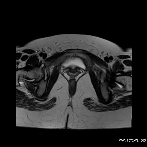 File:Bicornuate uterus- on MRI (Radiopaedia 49206-54297 Axial T2 15).jpg