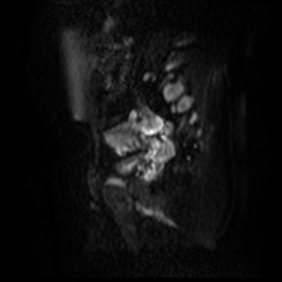 File:Bicornuate uterus (Radiopaedia 51676-57472 Sagittal DWI 18).jpg