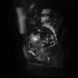 File:Bicornuate uterus (Radiopaedia 51676-57472 Sagittal DWI 40).jpg